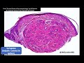 Skin Adnexal Tumors 101: A Basic Approach for General Pathologists