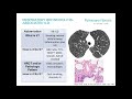 Idiopathic Interstitial Lung Diseases: When a Cause is Truly Unidentifiable Webinar