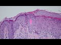 Grover's Disease (Transient Acantholytic Dermatosis): 5-Minute Pathology Pearls