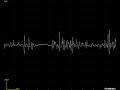 Dermatomyositis deltoid EMG