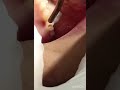 how a composite filling is done in tooth.