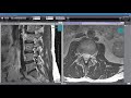 How to Read Your MRI with Onis 2.5 - part 2 of 2 (Advanced Lumbar Spine MRI Anatomy)