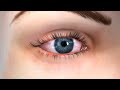 Dry Eye Causes and Treatment