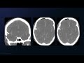 Trapping and Resection of a Mycotic M4 MCA Aneurysm with STA-MCA Bypass