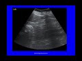 LIVESCAN 1 Endometriosis