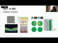 MS and Optical Coherence Tomography: Eyes Don't Lie