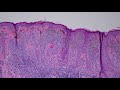 Melanocytic Dermpath Basics: Benign Nevus