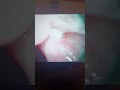 my huge tonsil stones first time removal ever very graphic removal