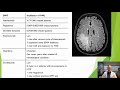 Ocrevus Side Effects Explained by Neurologist