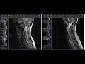 Degenerative Changes of the Cervical Spine on MRI