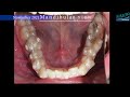 INVISALIGN treatment for 10 MONTHS! 4k time-lapse.