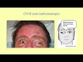 Stroke Syndromes (updated 2023) - CRASH! Medical Review Series