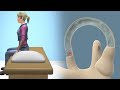 Epley Maneuver to Treat BPPV Dizziness