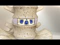 STALIF M™ (MIDLINE II) Surgical Technique Animation | Anterior Lumbar Interbody Fusion