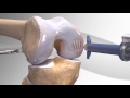 Cartilage Repair with Arthrex® BioCartilage® (Knee)