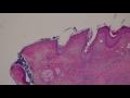 Basal Cell Carcinoma (BCC) 101 - Dermpath Basics Explained by a Dermatopathologist