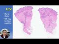 DERMATOPATHOLOGY: Vasculitis, Vasculopathy & More