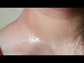 Skin Repair | Close Large OPEN PORES in 1 week, Remove Dark Spots, Anti Aging