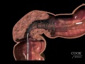 Evolution® Colonic Controlled-Release Stent - Uncovered Endoscopic Animation