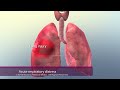Common Causes of Respiratory Failure