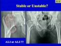 Peritrochanteric Fractures- DHS Vs IM Nail