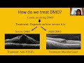 New laser treatment for diabetic macular oedema (DMO)