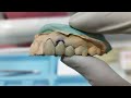 dental bridge..