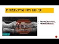 OCT in diabetic Retinopathy || OCT patterns of DME || Biomarkers in OCT