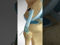 See how an ACL LCL Tear is repaired