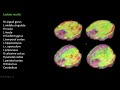 ME/CFS Involves Brain Inflammation: Results from a Ramsay Pilot Study