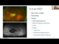 Webinar: Macular dystrophies - Diagnosis and Management