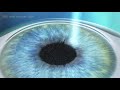 PRK vs. LASIK- What's the Difference?