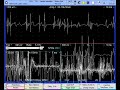 myopathy VM