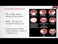 Interpreting MRI of the spine As simple as ABCD