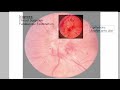 Idiopathic Intracranial Hypertension (Pseudotumor Cerebri) | Causes, Symptoms, Diagnosis, Treatment