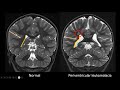 Imaging the preterm brain! Periventricular leukomalacia and beyond.