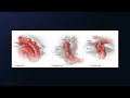 Microsurgical Clipping of a Ventral Wall ICA Aneurysm with Intradural Clinoidectomy