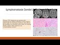 Pursue 7 Z A1 :Primary CNS Lymphoma