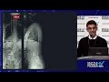 What Are the Optimal Alignment Parameters in Adult Deformity Surgery? - Alekos Theologis, M.D.