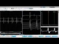 What does jitter tell us about complex repetitive discharges?