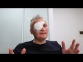 vitrectomy for floaters - post surgery recovery - day 1