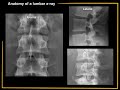 Anatomy of a Lumbar x-ray