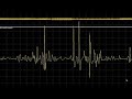 Syndrome d'Isaac : neuromyotonies + myokymies