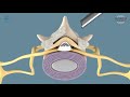 Spinal Stenosis - Full-endoscopic decompression at the lumbar spine with VERTEBRIS stenosis