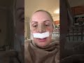 Day 4 post op-rhino/septoplasty and otoplasty!