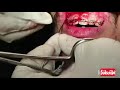 frenectomy during orthodontic treatment